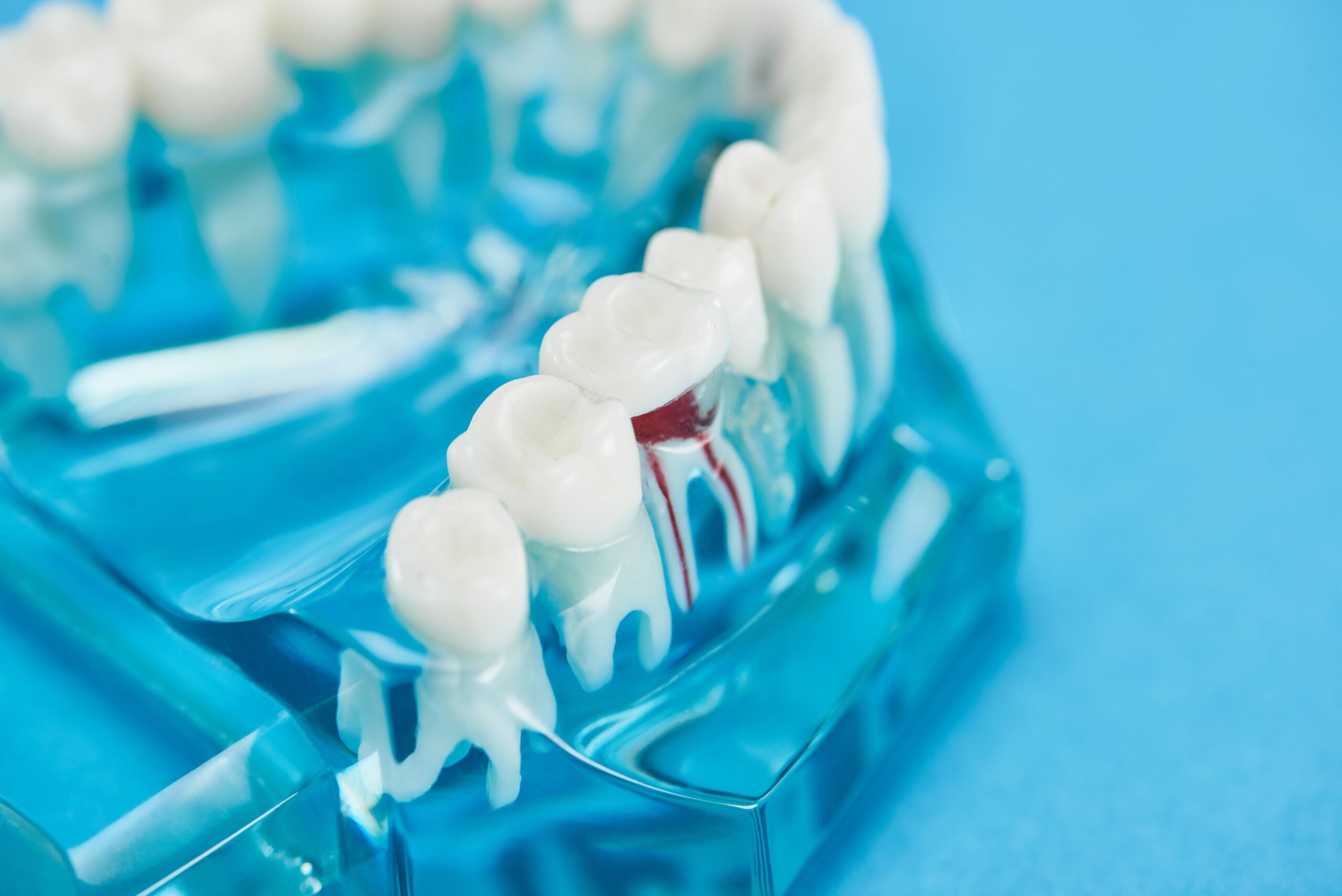 Jak wygląda leczenie kanałowe - Model zębów na tle niebieskim