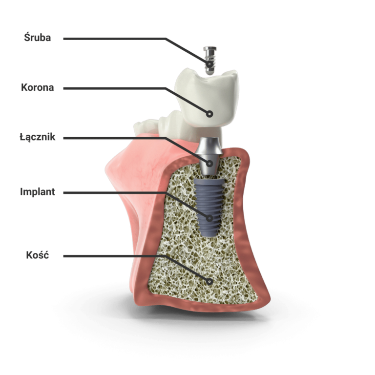 Implanty Wrocław - schematyczne przedstawienie budowy implantu zębowego
