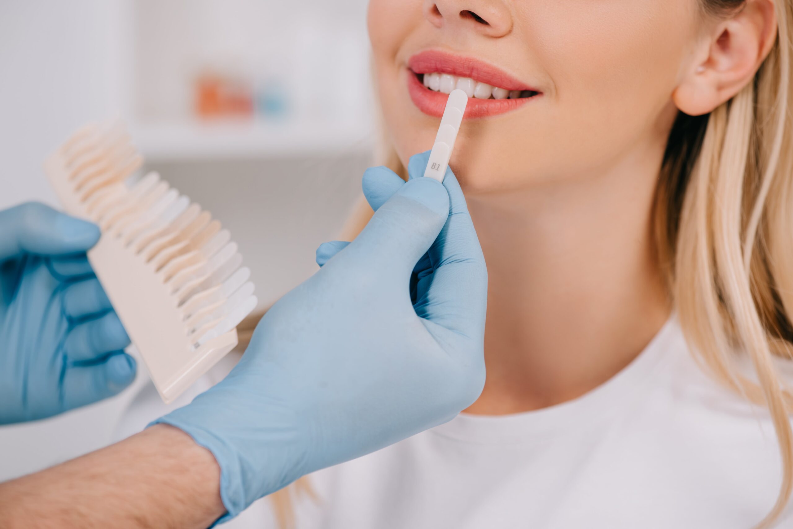 Wybielanie zębów nakładkami - dentysta dobierający odcień nakładki wybielającej do naturalnej barwy zębów pacjenta