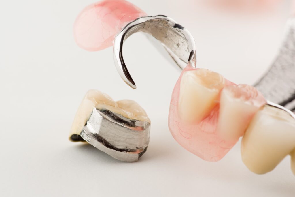 Zbliżenie na część protezy zębowej z metalowym klamrowym mechanizmem mocującym i oddzielonym koronowanym zębem, osadzonym na różowej akrylowej bazie.