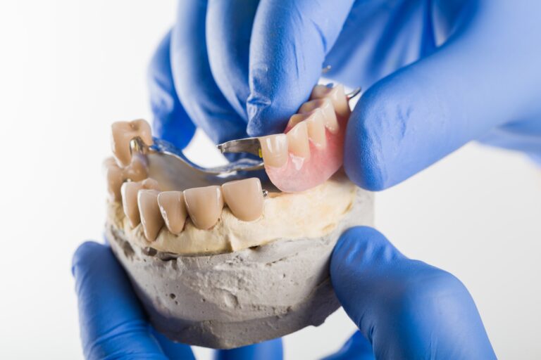 Proteza szkieletowa - Dobry stomatolog prezentuje protezę szkieletową.