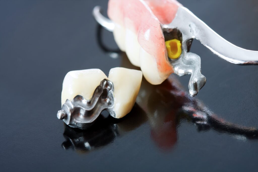 Zatrzaski, zamocowane na specjalnych koronach na zębach filarowych, działają jak guziki zatrzaskowe, umożliwiając pewne utrzymanie konstrukcji.