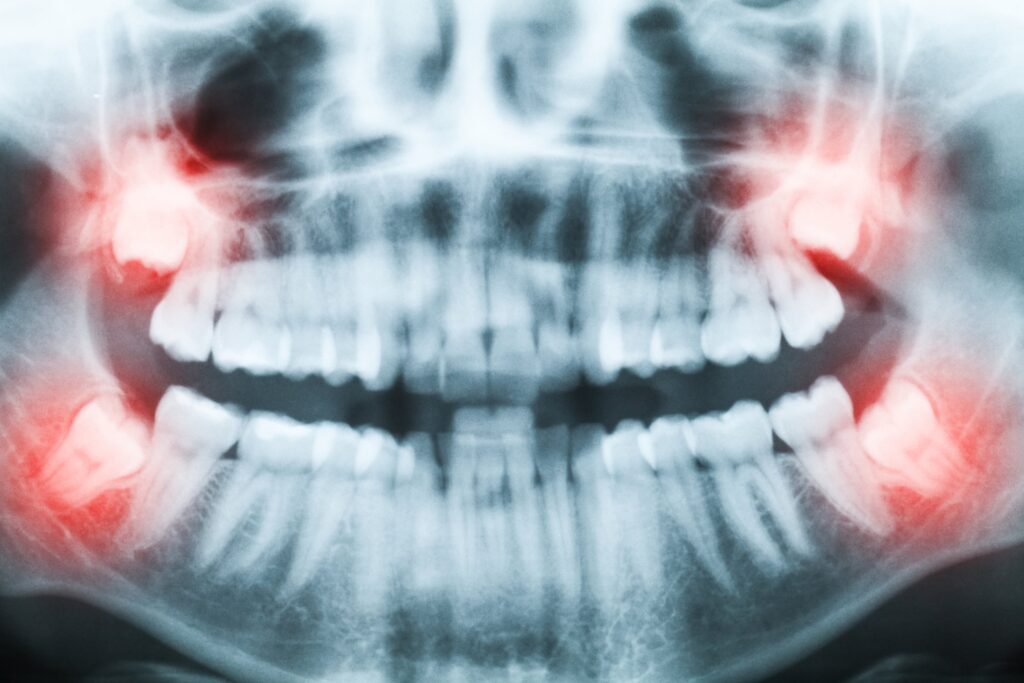 Zdjęcie RTG przedstawiające zatrzymane zęby mądrości, które mogą powodować ból, infekcje i inne komplikacje zdrowotne.