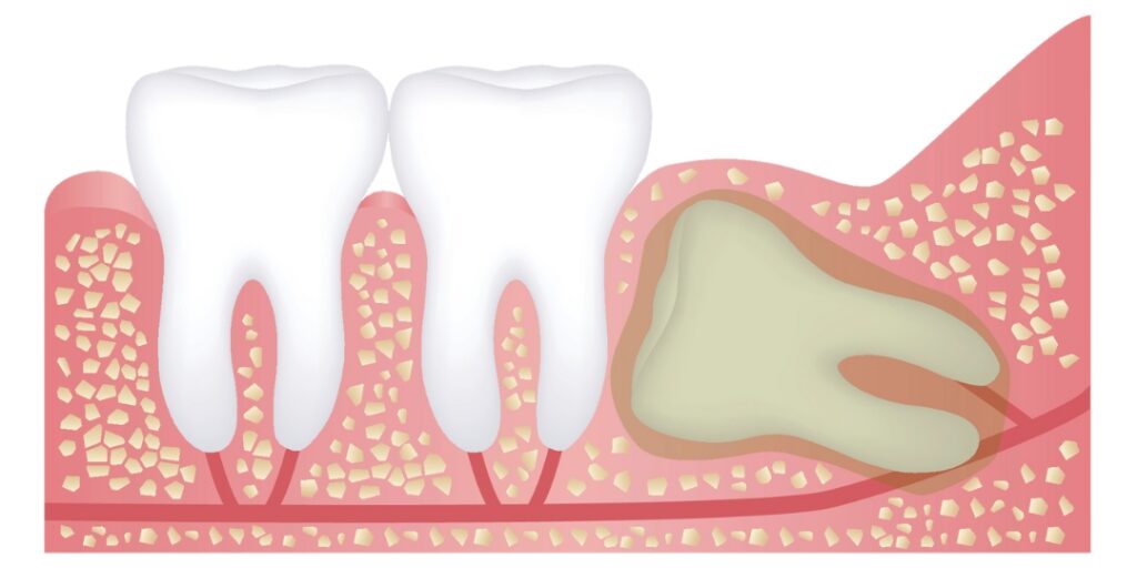 Ząb zatrzymany z torbielami - Zatrzymane zęby mogą powodować powstawanie torbieli w szczęce lub żuchwie, co może prowadzić do dalszych komplikacji zdrowotnych.