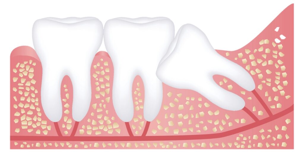 Zatrzymany ząb spowodowany stłoczeniem - Brak miejsca w łuku zębowym to jedna z głównych przyczyn zatrzymania zębów. Stłoczone zęby mogą uniemożliwiać prawidłowe wyrzynanie się nowych zębów.