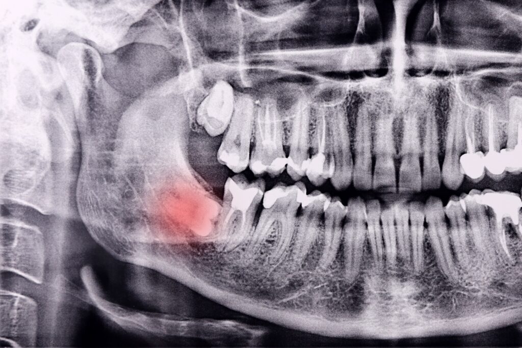 Poziome zapalenie zęba mądrości na panoramicznym badaniu rentgenowskim zęba zęba.