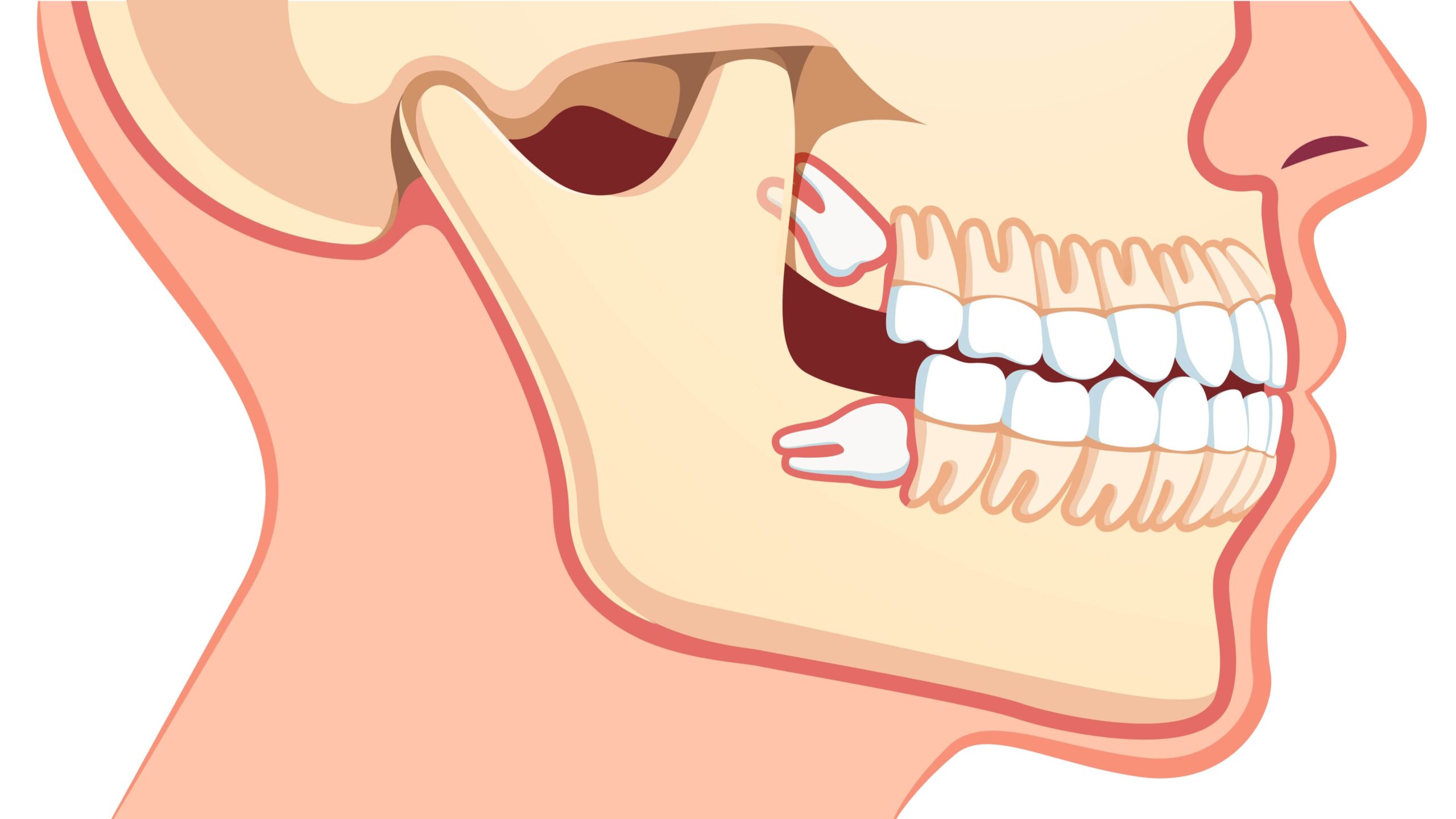 Ząb zatrzymany – jakie są jego objawy i jak go leczyć?