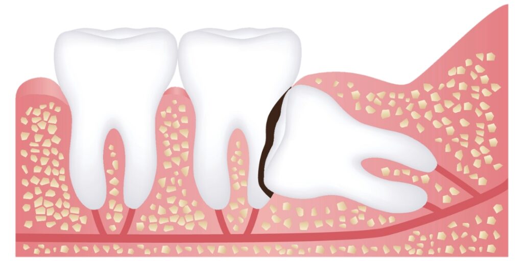 Ząb zatrzymany z ubytkami erozyjnymi - Zatrzymane zęby mogą prowadzić do poważnych ubytków, które trudno jest leczyć. Nieleczone mogą powodować dalsze uszkodzenia i infekcje.