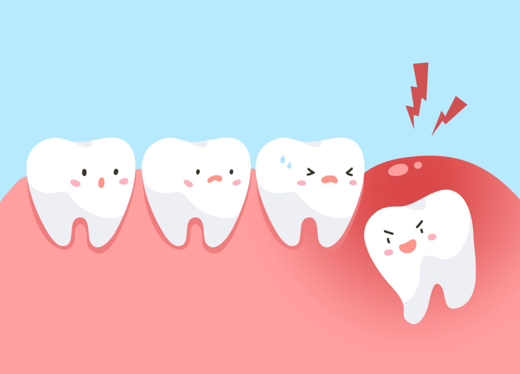 Zatrzymane zęby negatywnie wpływają na zdrowie jamy ustnej. Odwlekanie leczenia niewyrżniętego zęba może skończyć się wieloma przykrymi konsekwencjami, z którymi wcześniej czy później będziemy musieli sobie poradzić.