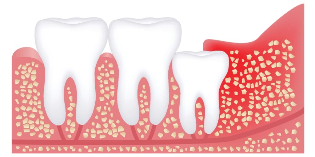 Ząb zatrzymany z infekcją - Zatrzymany ząb może prowadzić do infekcji dziąseł i otaczających tkanek. To często objawia się bólem, obrzękiem i zaczerwienieniem dziąseł.