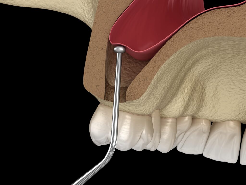 Podniesienie dna zatoki Sinus Lift. Etap uniesienia błony zatokowej narzędziem chirurgicznym.