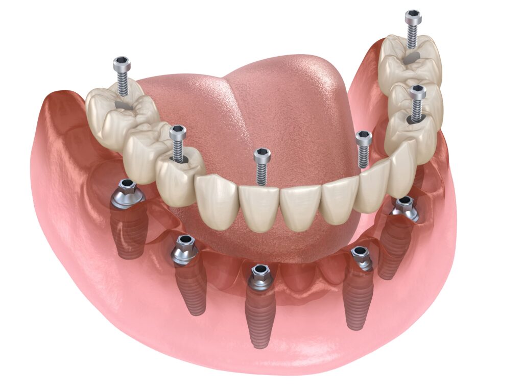 Proteza zębowa żuchwowa All-on-6 wspierana przez sześć implantów dentystycznych, precyzyjna ilustracja 3D ukazująca protetyczne zęby osadzone na różowym dziąśle, zapewniająca kompleksowy obraz nowoczesnej metody odbudowy uzębienia.