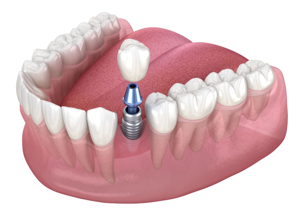 Ilustracja 3D przedstawiająca implant zęba z łącznikiem i koroną porcelanową, założony w miejsce brakującego zęba, otoczony naturalnymi zębami, ukazujący założenie korony.