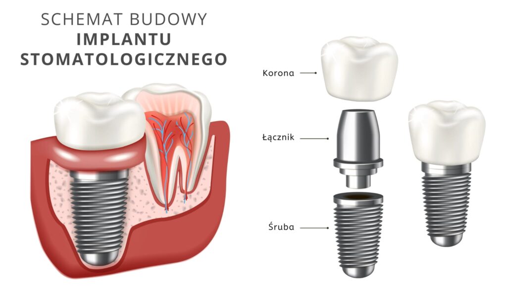 Koszt implantów zębowych - Schemat budowy implantu stomatologicznego: korona porcelanowa, łącznik i śruba. Jeden implant umieszczony przy naturalnym zębie, ukazujący różnice między strukturą implantu a naturalnym korzeniem zęba.