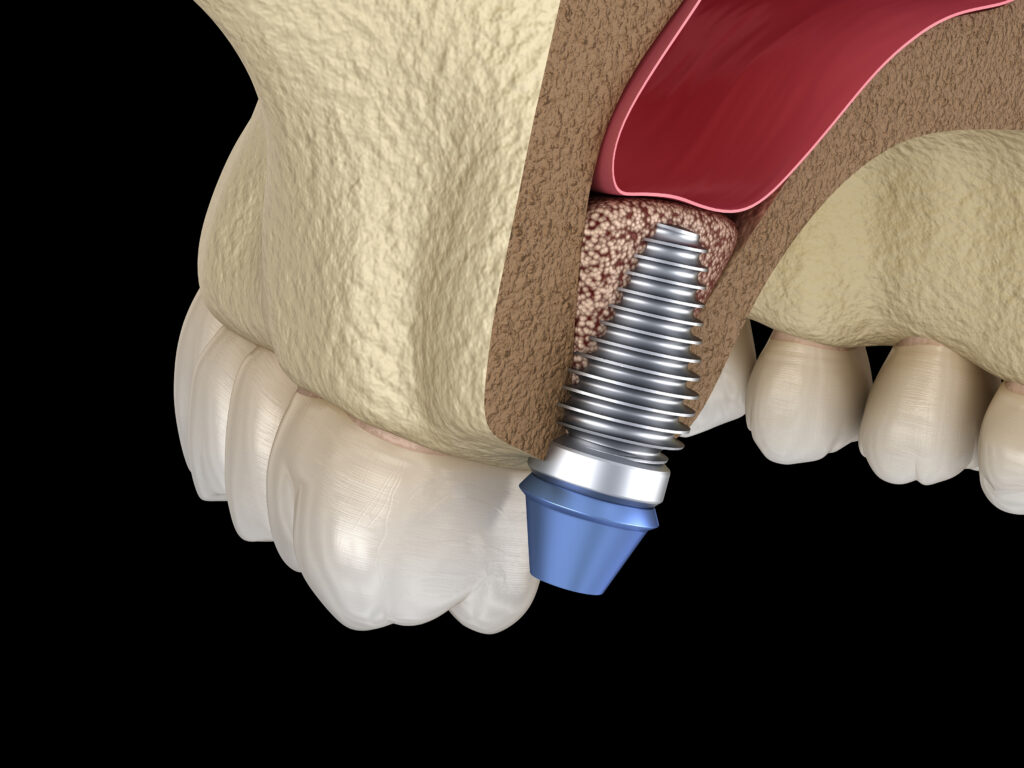 Ilustracja 3D końcowego etapu sinus lift z implantem zęba wszczepionym w kość szczęki, zastępującym korzeń zęba.