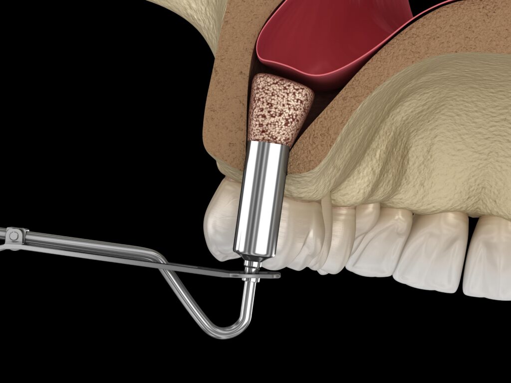 Ilustracja 3D wprowadzania materiału kościotwórczego podczas procedury podniesienia dna zatoki szczękowej (sinus lift).