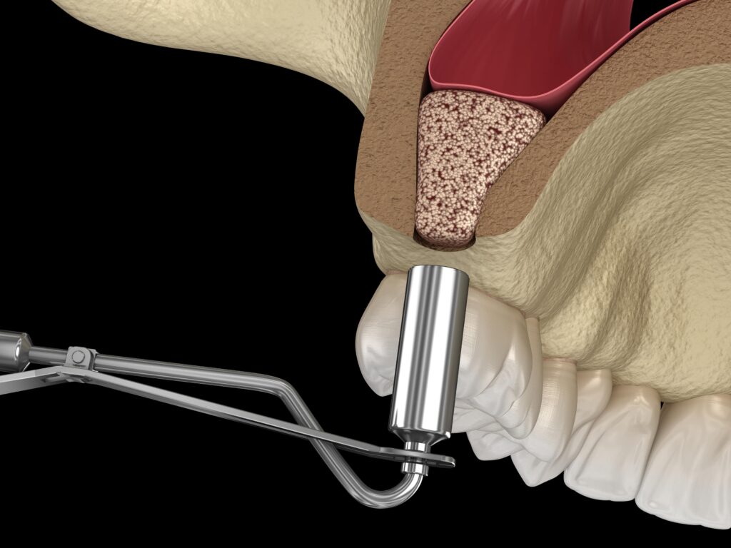 Ilustracja 3D przedstawiająca wprowadzony materiał kościotwórczy podczas procedury podniesienia dna zatoki szczękowej (sinus lift), zwiększający objętość kości w przypadku niewystarczającej ilości tkanki kostnej.