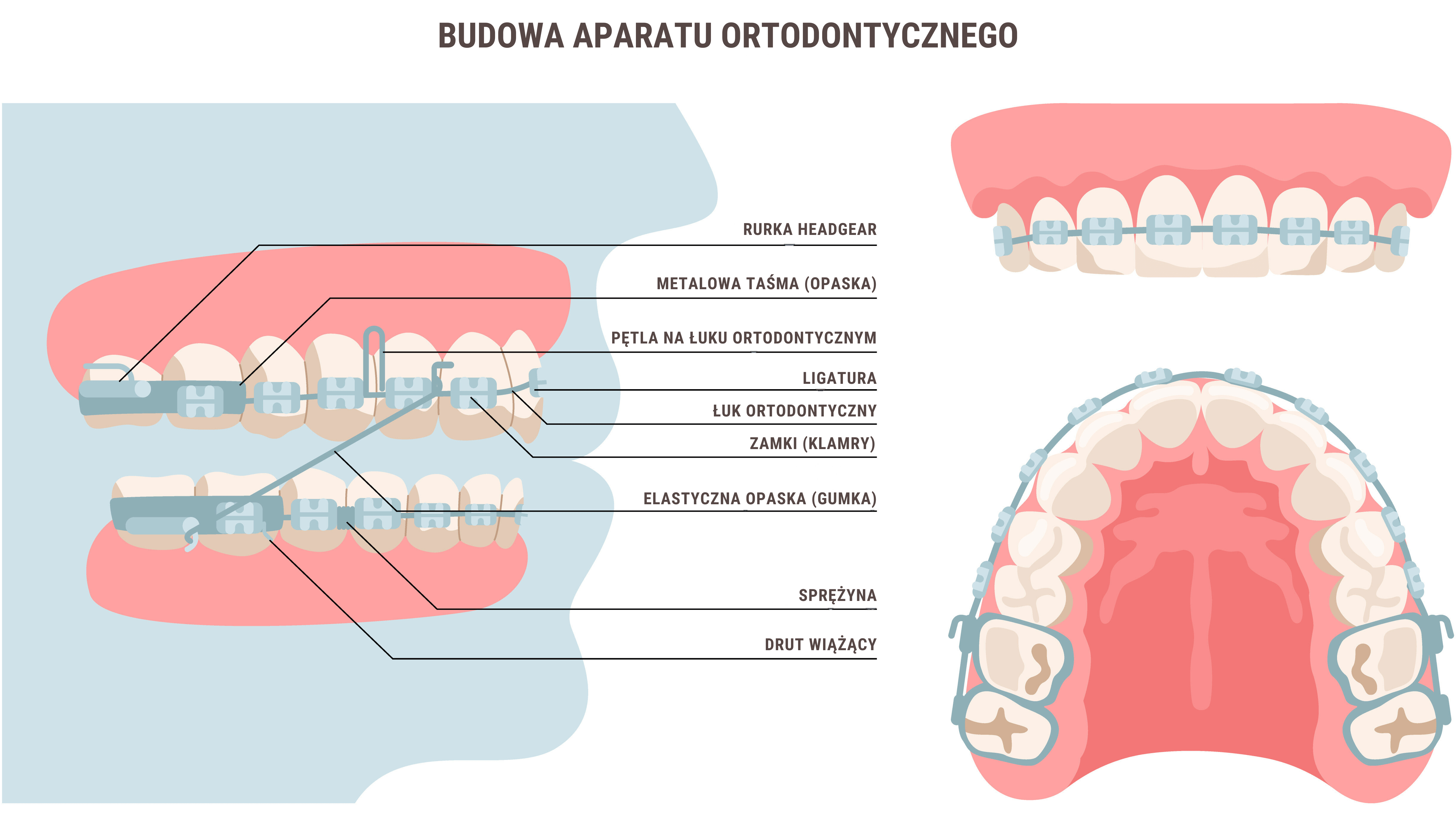 Aparat ortodontyczny stały - jak jest zbudowany?