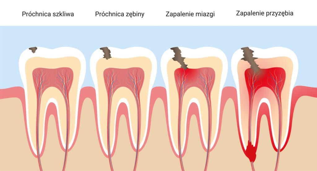 Etapy rozwoju problemów z zębami: od próchnicy szkliwa, przez próchnicę zębiny, zapalenie miazgi, aż do zapalenia przyzębia.