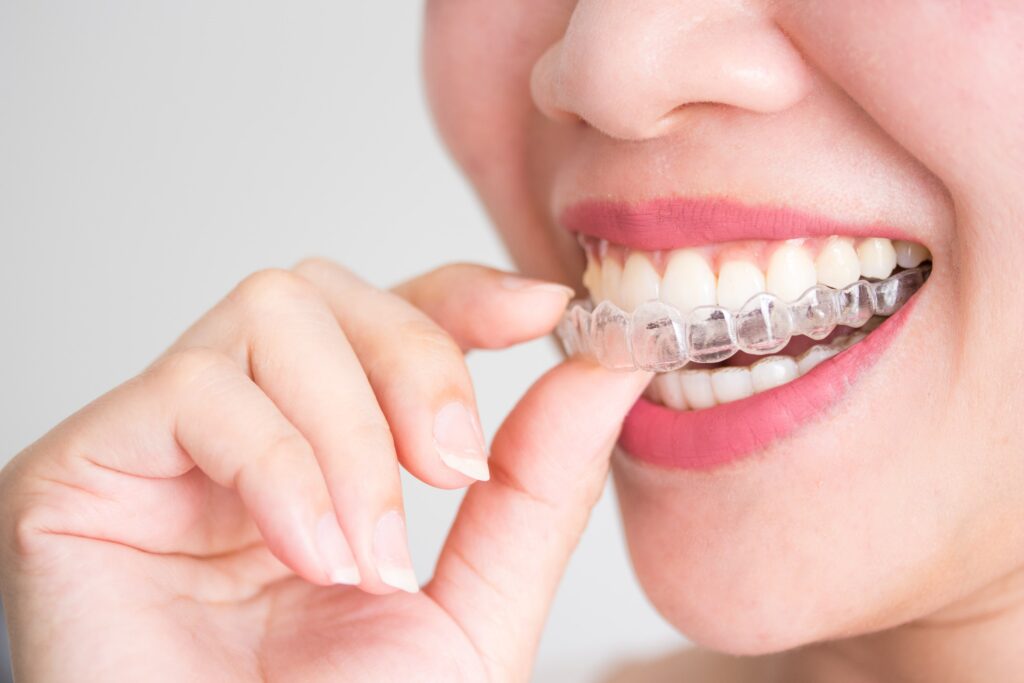 Zbliżenie na kobietę zakładającą ruchomy aparat estetyczny Invisalign na zęby.