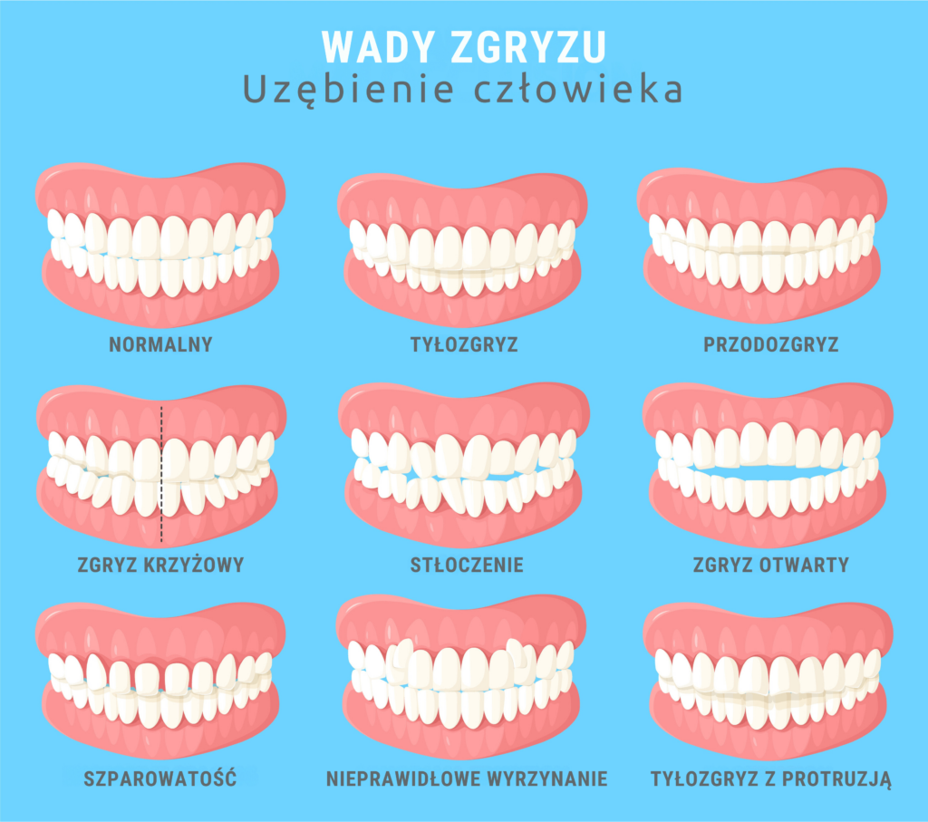 Jakie są wady zgryzu?