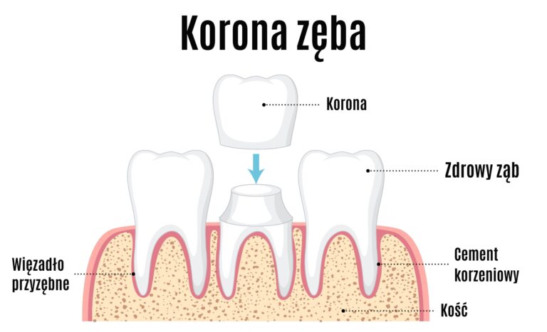 Ile kosztuje korona zęba w 2025 roku? Korona zęba jak wygląda?